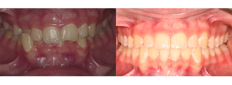 <p><strong>Anterior Crossbite</strong><br><br>This patient wore braces for less than 2 years to help correct the bite and alignment.  Now the upper teeth cover the lower teeth, fixing the crossbite.
