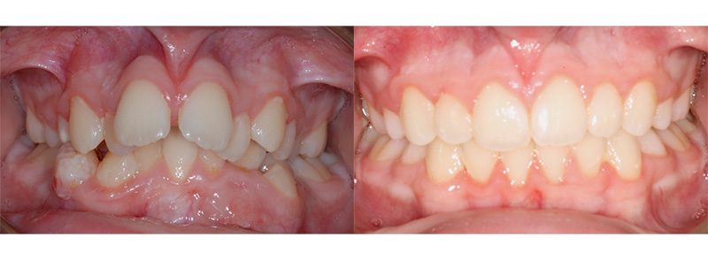 <p><strong>Overjet</strong><br><br>Treatment was done in 2 phases for the patient to fix the bite and fix the crowding.  The severe overjet left the upper front teeth far in front of the lower teeth, not allowing the teeth to touch when chewing.  The first phase was done in conjunction with removal of some permanent teeth and upper braces only.  The second phase involved full braces to align the teeth and fix the bite.