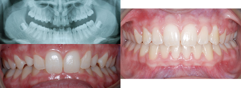 <p><strong>Impacted (Unerupted) Teeth</strong><br><br>Impacted canines impact 2% of the population.  Some steps can be taken while young to help erupt.  The canines for this patient did not respond to early measures taken by the dentist (i.e. early removal of selected baby teeth) and were positioned on the roof of the mouth.  Following 12 months of early braces to create space for the impacted canines, the patient was referred to an oral surgeon to uncover and place a brace on each canine.  They were pulled into position.  Finally the bite was fixed and all teeth straightened.  Treatment post-surgery lasted 17 months.  The patient now has all of her natural teeth and doesn’t need to pursue costly dental implants. 