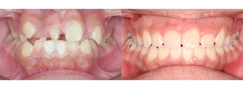 <p><strong>Crowding and Rotations of the Teeth</strong><br><br>Patient wore full braces for 25 months to get an excellent result.  For one year prior to her full braces, limited treatment was done on her maxillary teeth to help spin the front teeth and remove excess gingival tissue (done with a laser in our office).