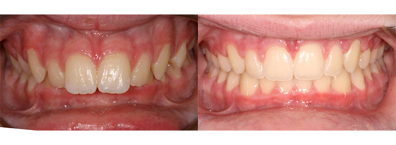 <p><strong>Deep Bite</strong><br><br>Treatment took 2 years to complete.  Opening the bite helps to reduced wear of the lower front teeth and also improves the cosmetics of the smile.