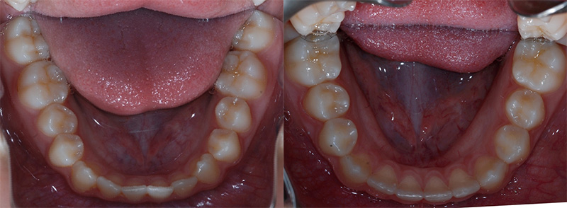 <p><strong>Invisalign</strong><br><br>This 15 year old patient wore Invisalign for 9 months to help align her lower teeth.  She loved being able to take out the appliances to clean her teeth and classmates loved how “invisible” her aligners were.