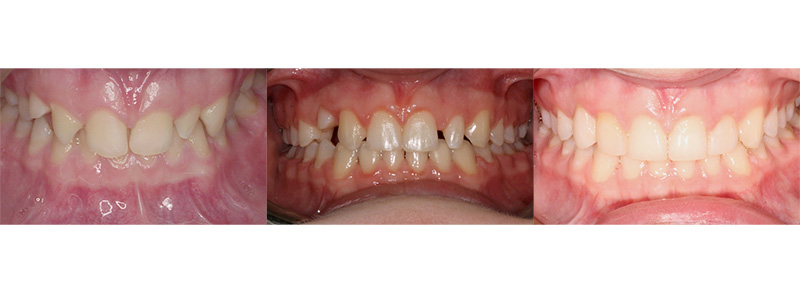 <p><strong>Missing Teeth</strong><br><br>Patient had missing front right lateral incisor and the same tooth on the left was small and pointy.  Working with her dentist, we positioned the teeth to have restorative work done.  The patient chose to keep one baby tooth long-term and plans to have a dental implant in the future if the baby tooth fails.  Treatment time took 2.5 years from start to finish, including restorative work.  (Dental work done courtesy of Dr. Amy Wilken)