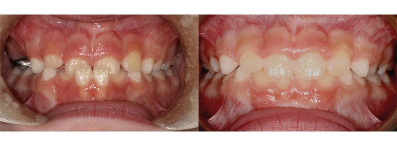 <p><strong>Phase 1 (Early Treatment)</strong><br><br>Treatment was done on at age 7 for this patient to prevent damage to the lower gums and prevent wear to the front teeth.  Treatment took 4 months to complete.