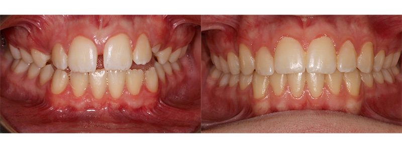 <p><strong>Spacing</strong><br><br>This patient wore full braces for 21 months to bring in his upper canines and close his large gap in his front teeth.  Wearing retainers helps to allow for the bone and gums to heal around the teeth, keeping the large gap closed for life.
