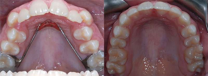 <p><strong>Space Maintenance</strong><br><br>This patient had a Nance appliance placed prior to starting orthodontic treatment.  This appliance can save space for developing permanent teeth to help prevent removal of permanent teeth.  All the permanent teeth were kept and braces treatment was completed in 2 years (lower braces only worn for 1.5 years of treatment)<br>The lower arch can also benefit from space maintenance, commonly with a lower lingual holding arch placed to preserve space.  Please ask if your child would benefit from a space maintainer while the permanent teeth are developing.