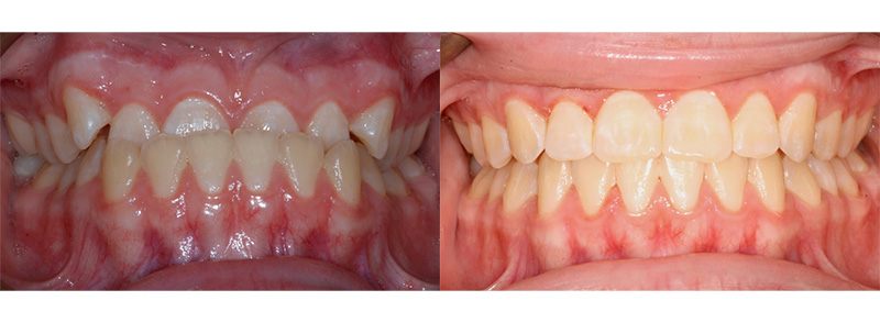 <strong>Underbite and anterior bite.</strong><br>><br>Braces by can complete covered div done fix for front full help her lower months negative now of off on only or patient previously removable retainer show straight strong teeth the this to upper were with worn